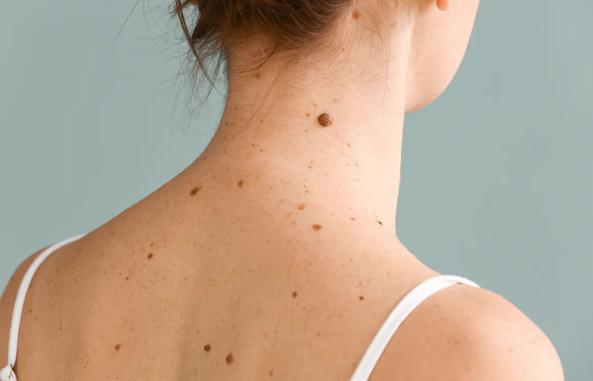 Dark Spots, Moles & Warts Removal