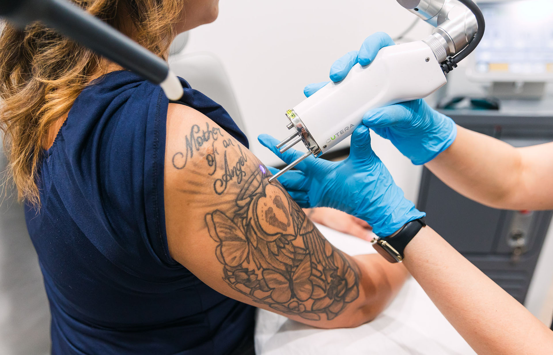 Laser Tattoo Removal