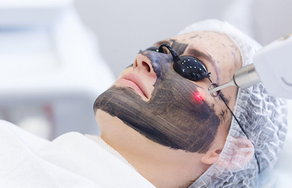 Carbon Laser Facial: A Radiant Glow